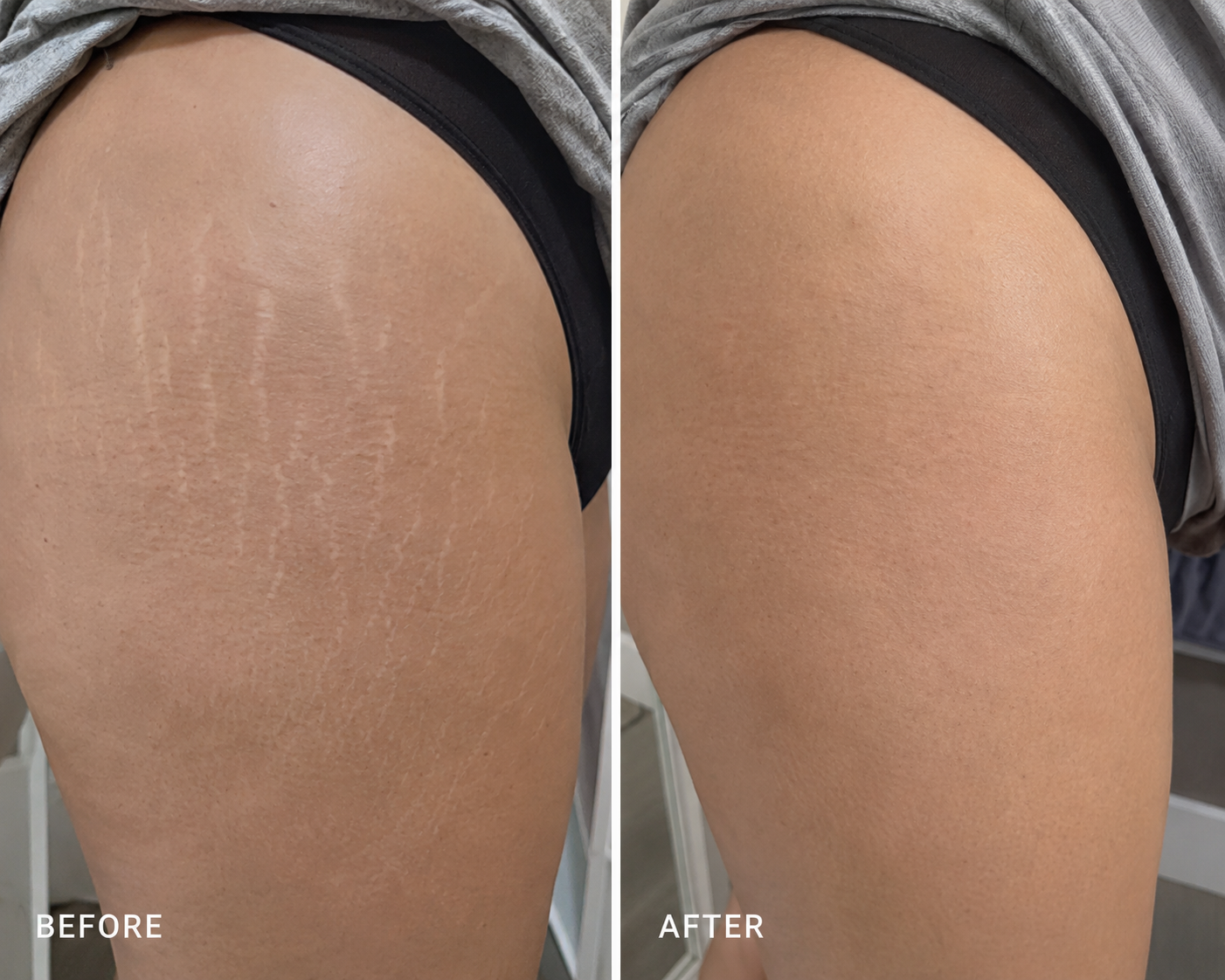 Stretch Mark Camouflage